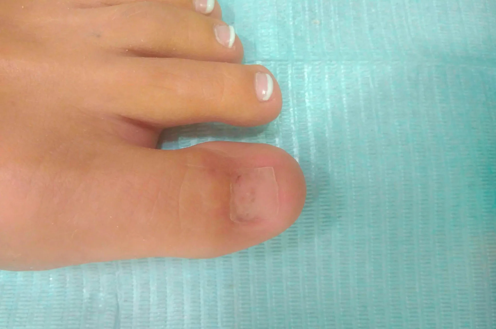 Reconstrucción de uñas